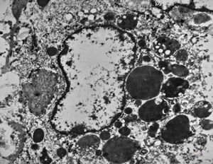 M,61y. | spleen - hemangioma v.s. … erythrophagocytosis M,61y. | spleen - hemangioma v.s. … erythrophagocytosis